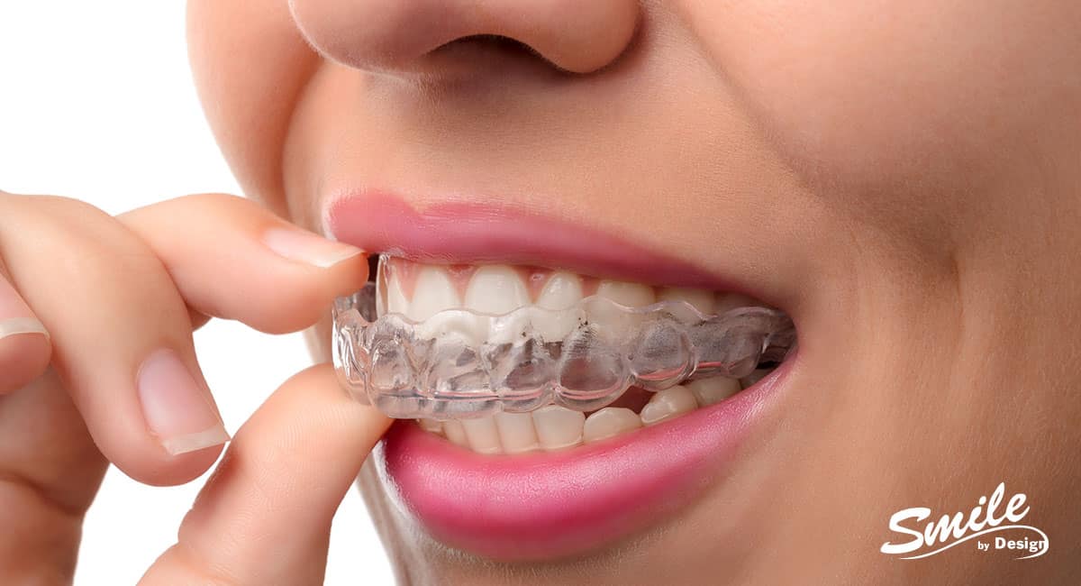 Invisalign® or Traditional Braces: Which Is Better?