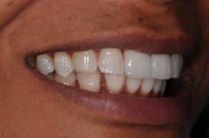 restorative method after
