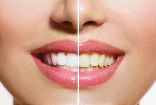 15 Easy Tips to Whiten Teeth