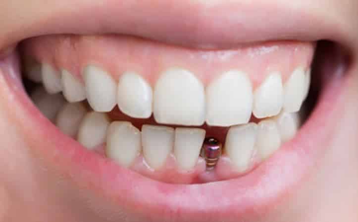 For Recently-Inserted Dental Implants