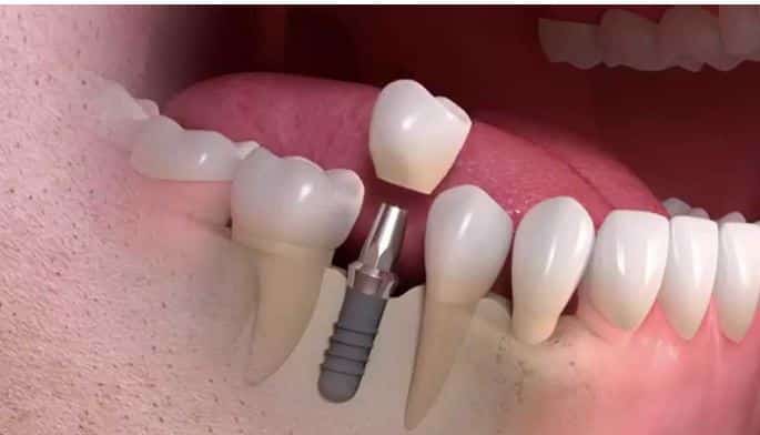 dental implant procedures