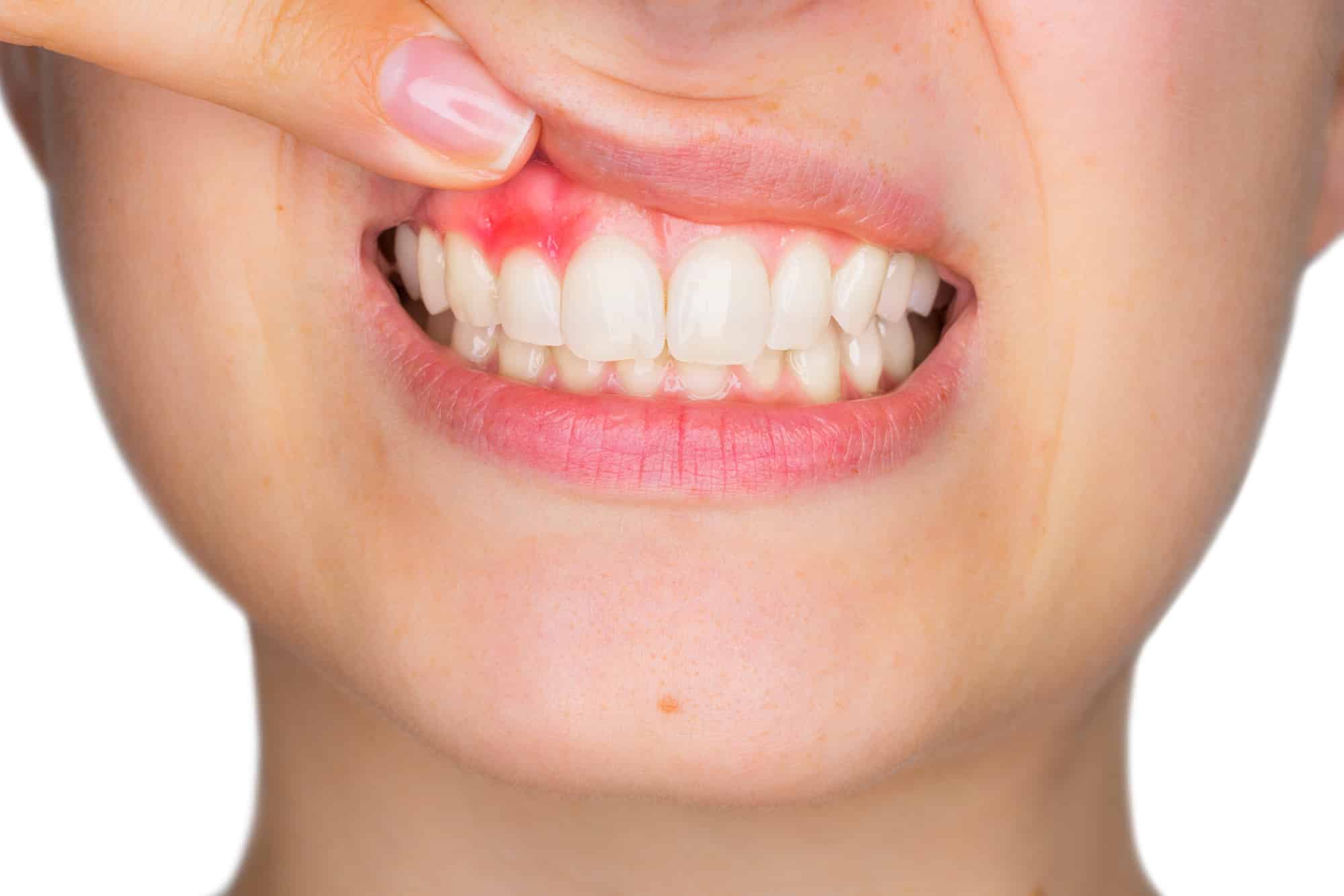 Why Bleeding Gums Should Not Be Ignored
