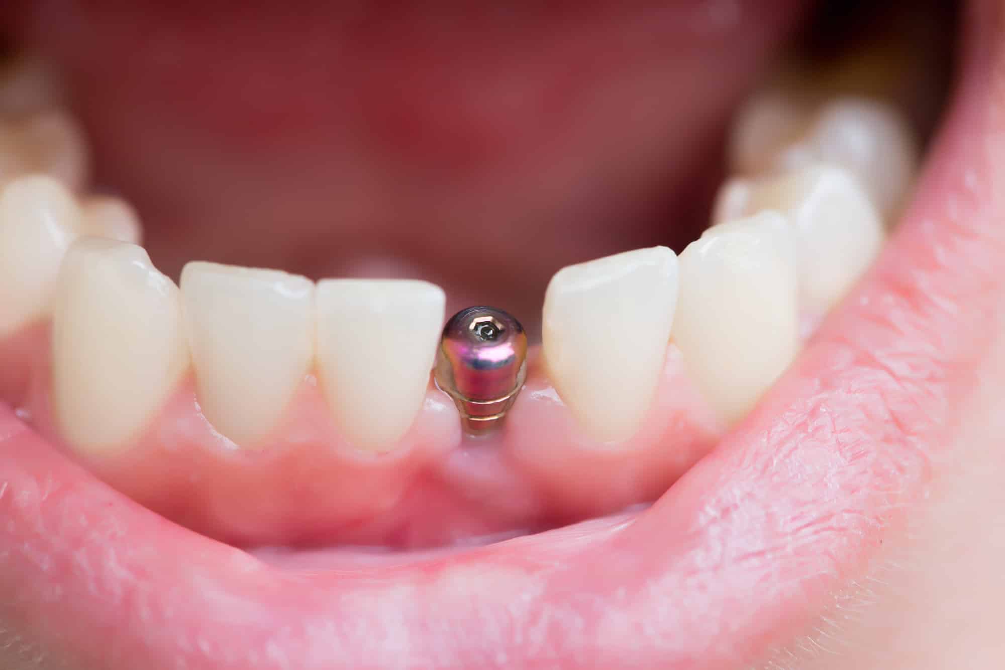 dental implants mississauga