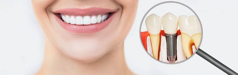 dental implants mississauga