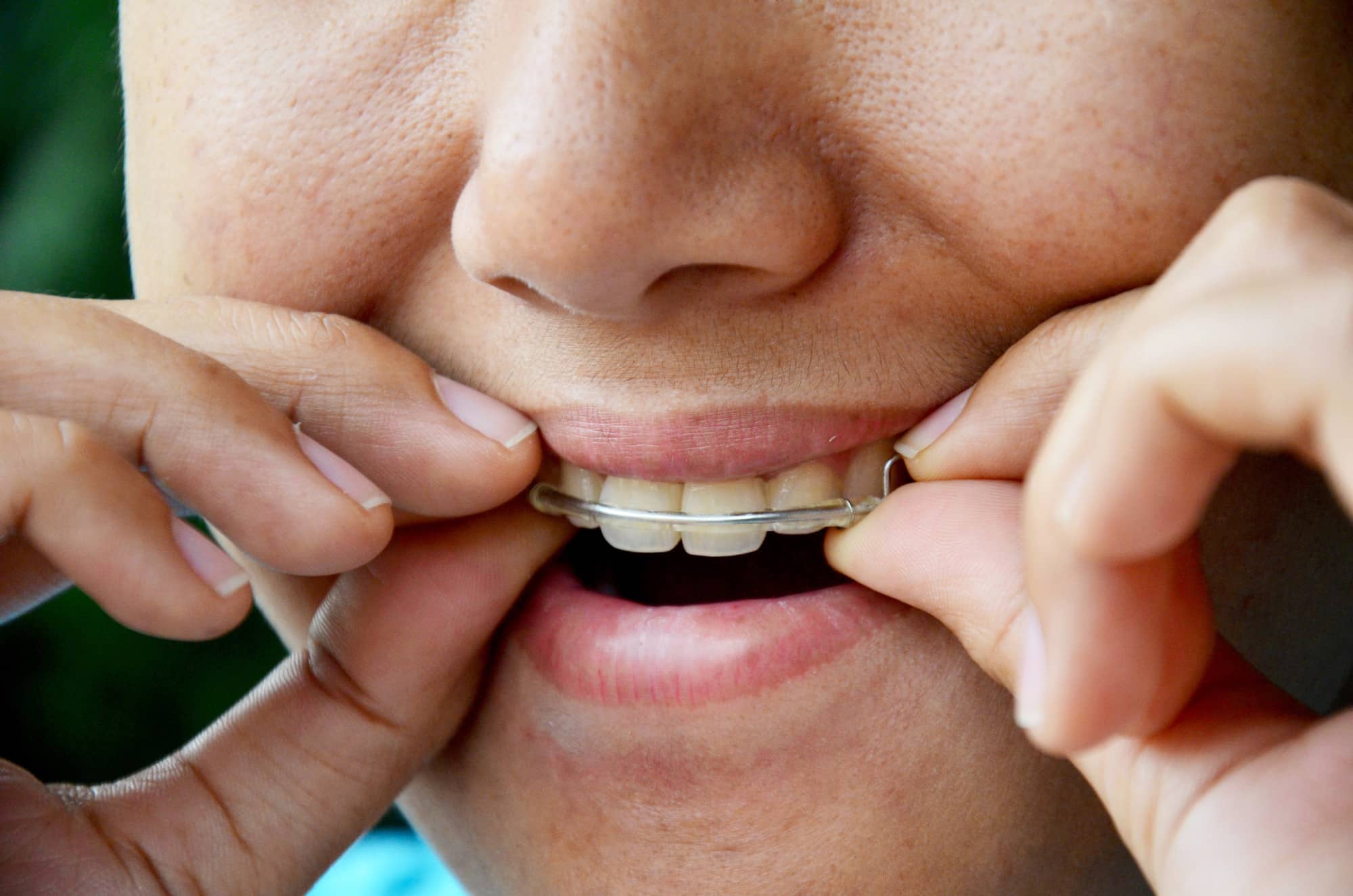 Why First Nations Are Battling Oral Health