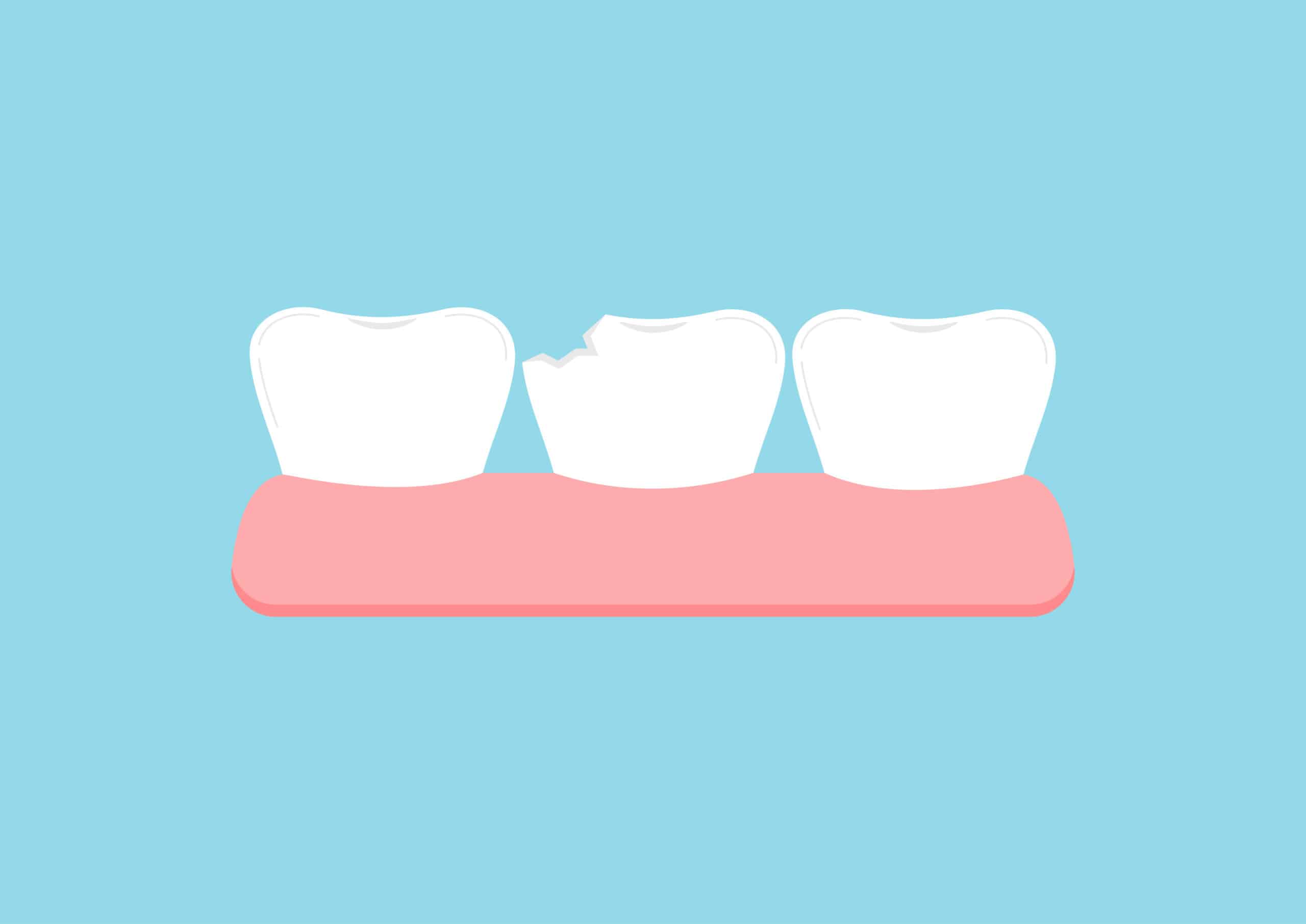 Chipped tooth in gum icon isolated on blue background.