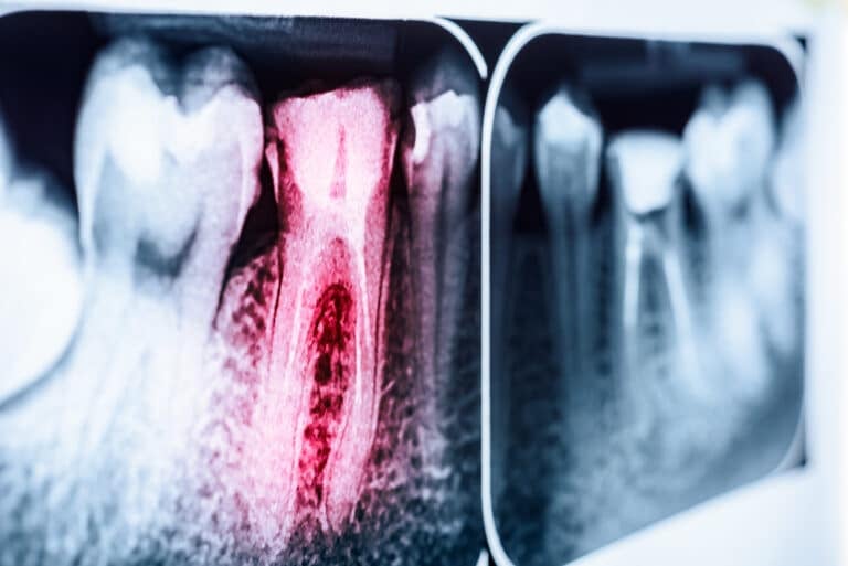 What Is a Root Canal?