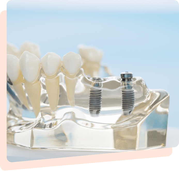 Dental Implants in Mississauga