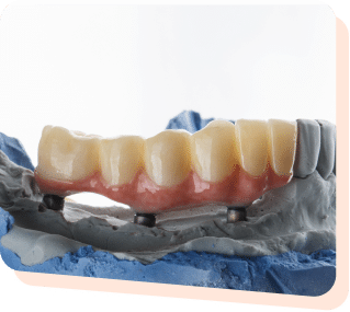 Dental Bridges in Mississauga