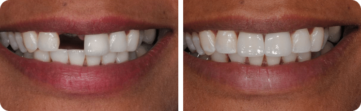 Dental implant success stories