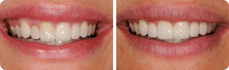 Dental implant transformations