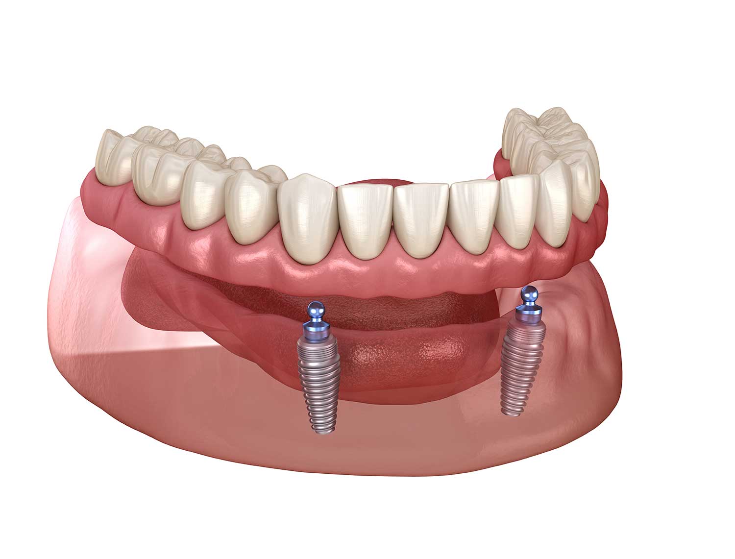 best dental implants mississauga