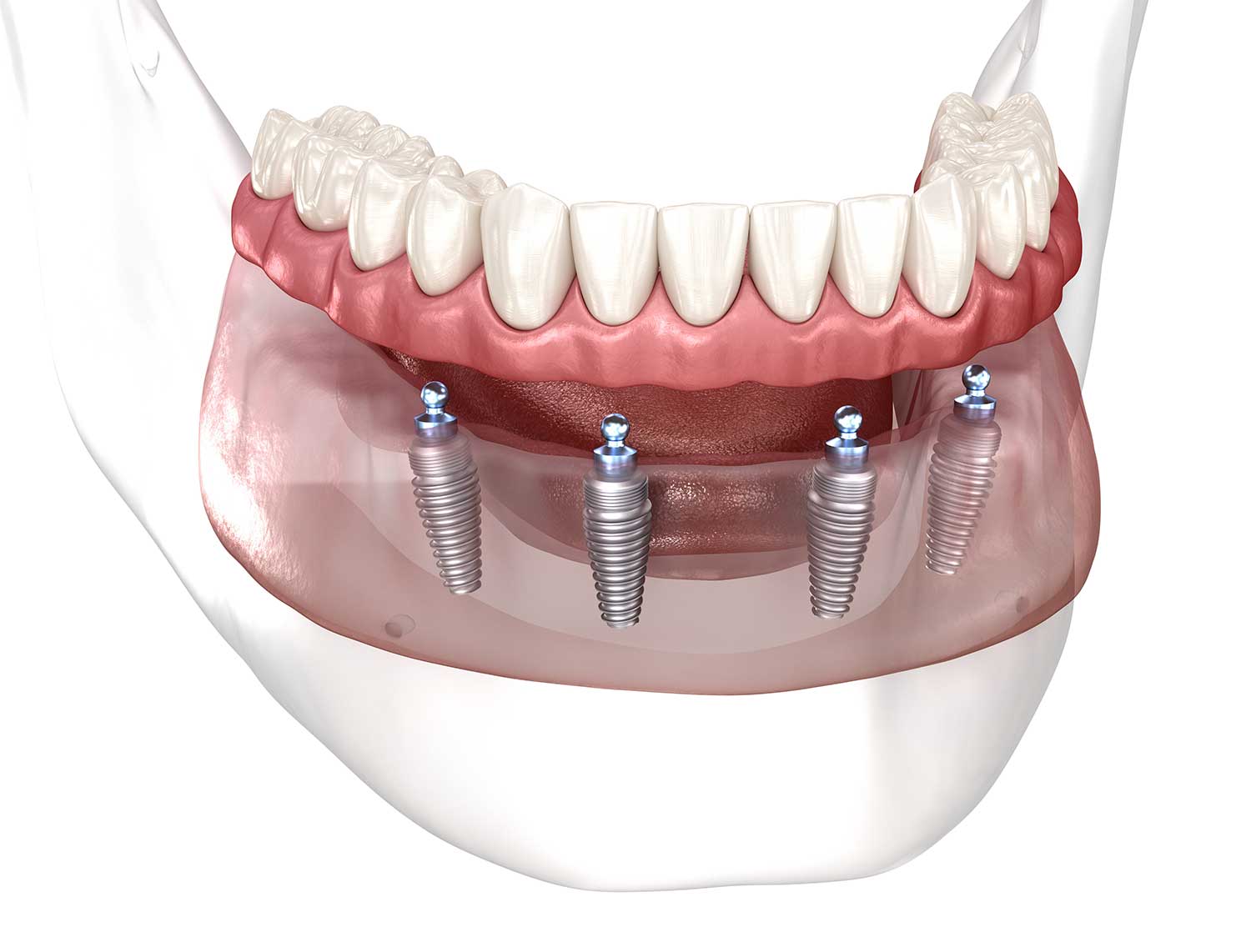 All-on-4 Implants Teeth in a Day