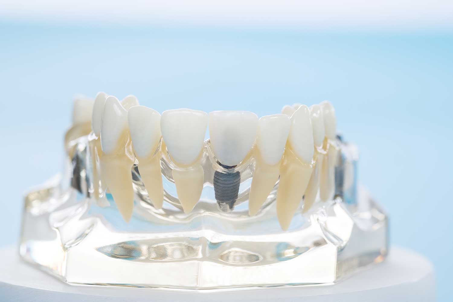 Dental Implants in Mississauga, ON