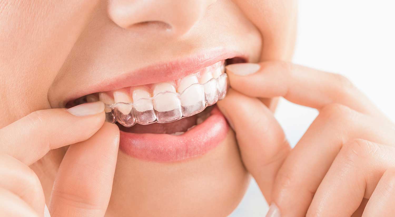 Teeth Straightening Near You
