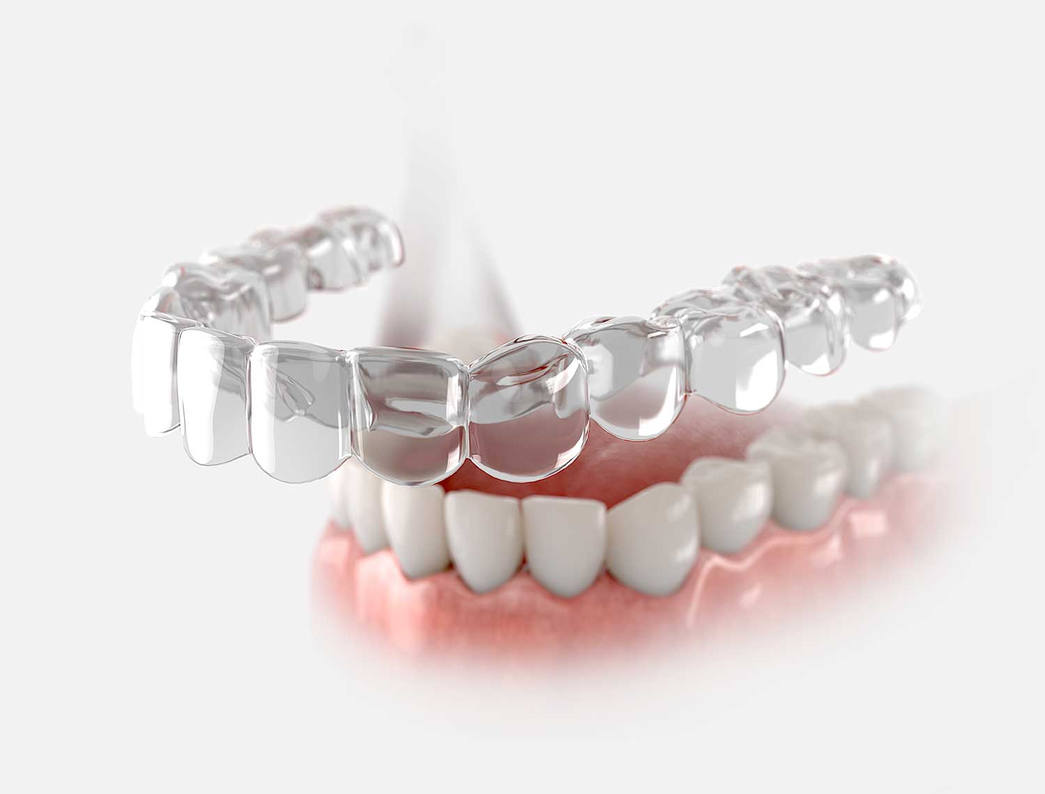 Invisalign braces