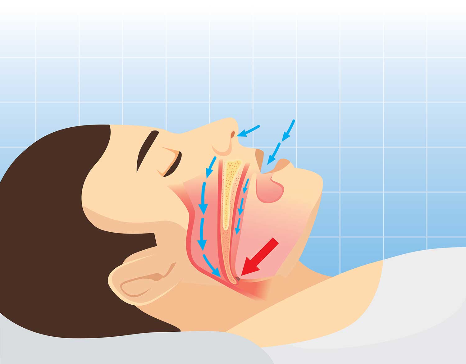 Sleep Apnea Treatment Options