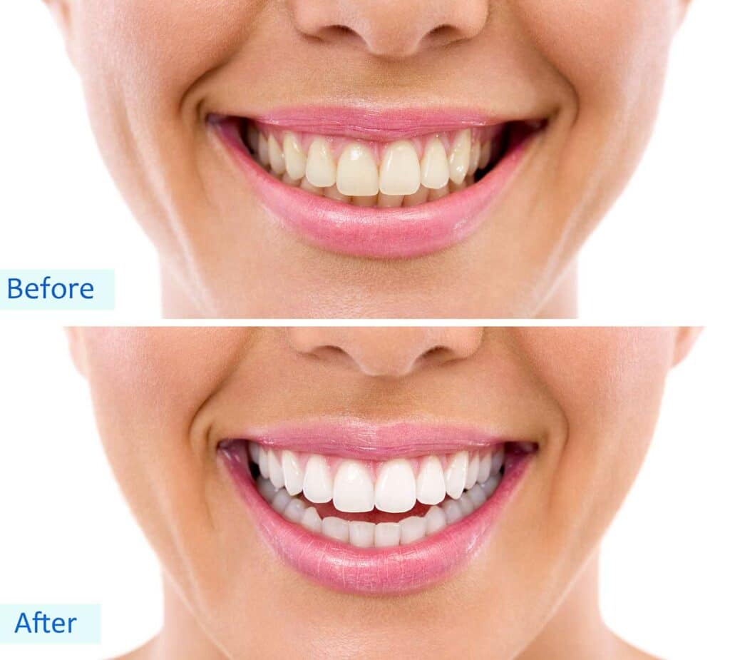 Zoom Tooth Whitening System