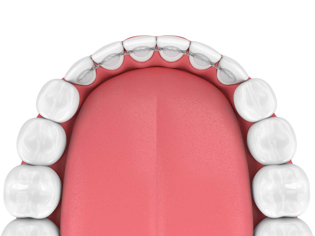 Cosmetic Dental Bonding in Mississauga Ontario Enhance Your Smile