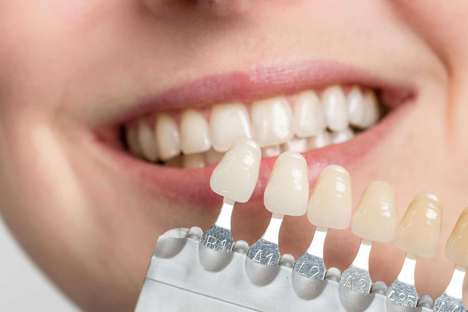 What Are Porcelain Veneers?