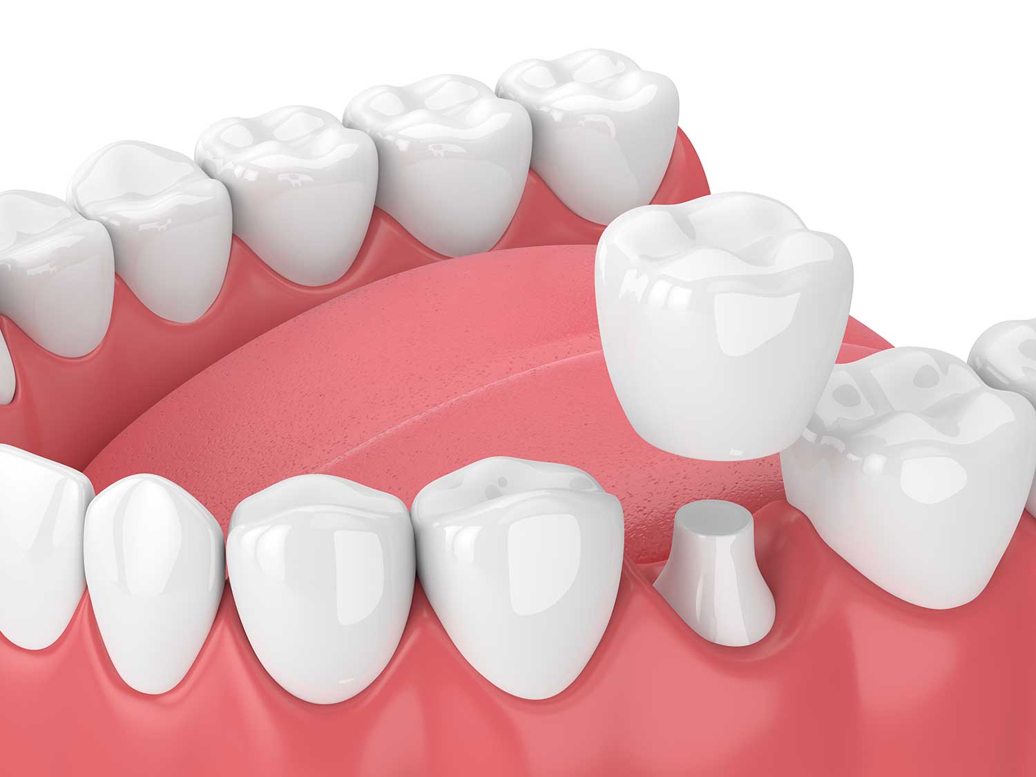 CEREC® Crowns