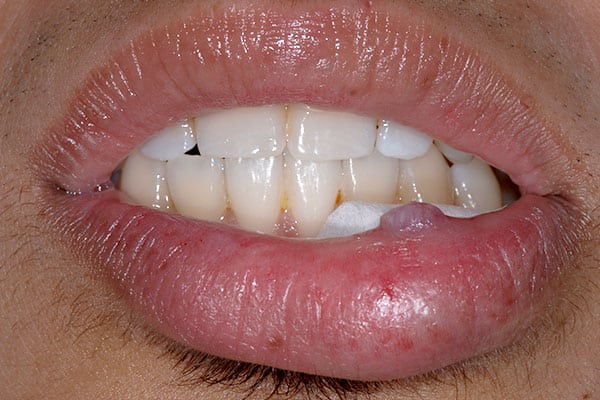 Mississauga teeth porcelain veneers close-up