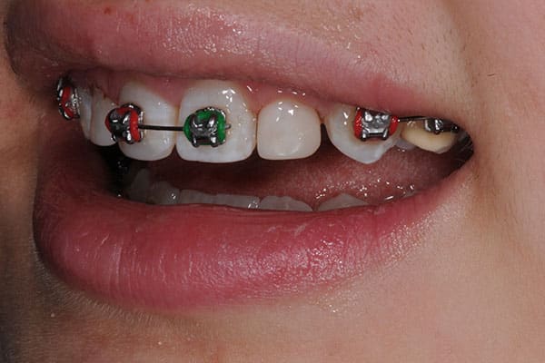 Braces transformation before and after