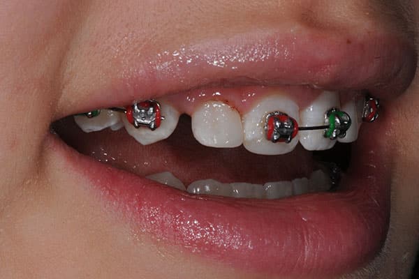 Mississauga teeth instant orthodontics transformation