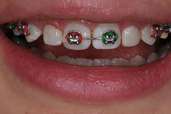 Braces transformation for a straight smile