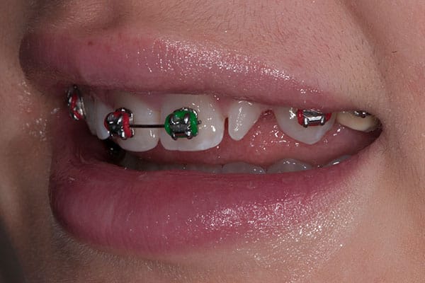 Teeth straightening transformation with braces