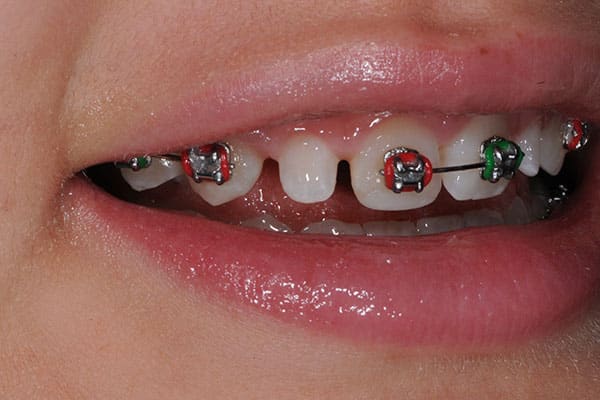 Braces transformation for a straight smile