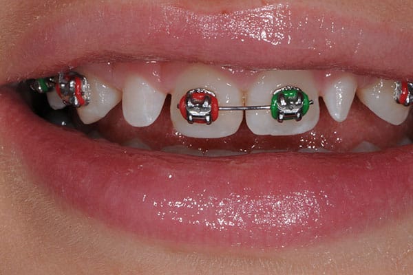 Orthodontic transformation for a beautiful alignment