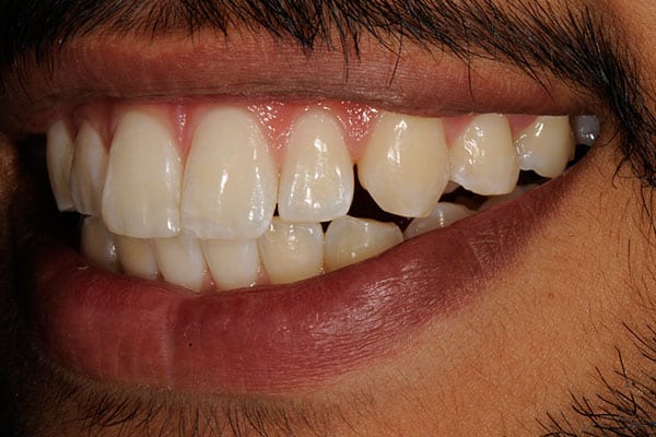 Teeth smile restoration transformation close-up