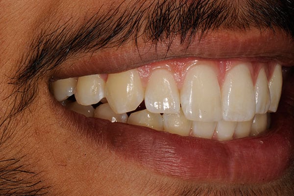 Full mouth reconstruction transformation for a complete dental makeover
