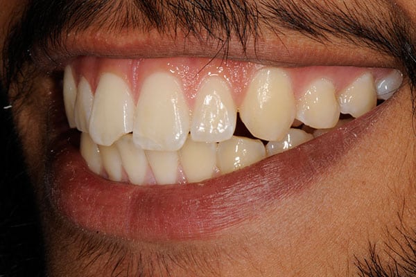 Porcelain veneers transformation close-up