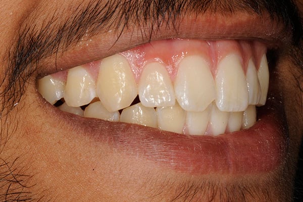 Teeth smile rejuvenation transformation before and after