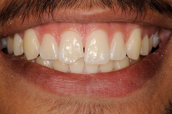 In-office teeth whitening transformation results