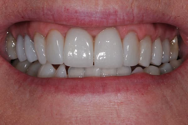 teeth ceramic veneers