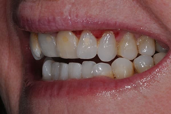 tooth enameloplasty transformation