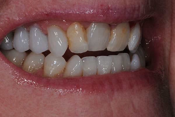 teeth straightening transformation