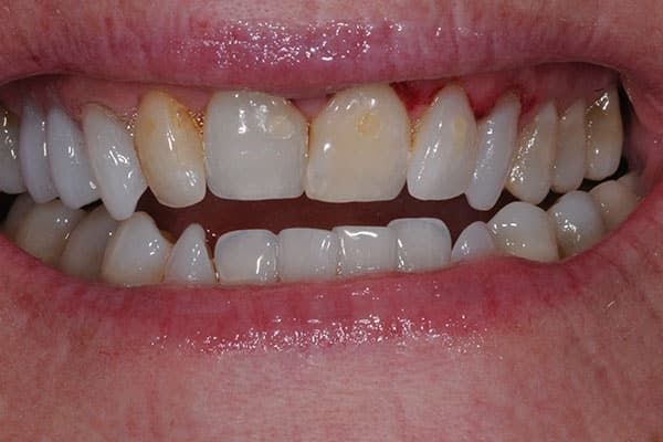 teeth porcelain veneers