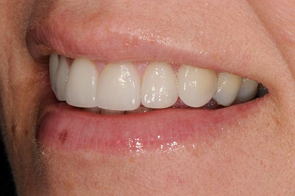 Mississauga gum contouring