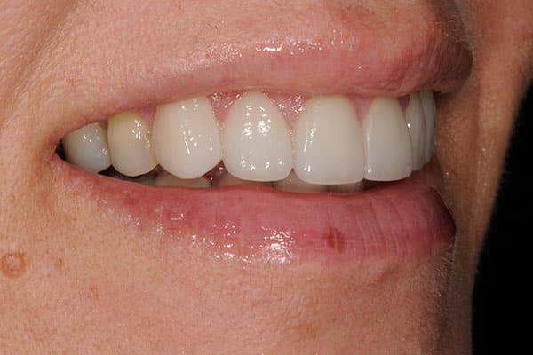 Mississauga smile makeover