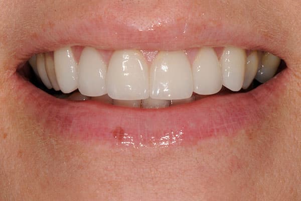 Mississauga smile rejuvenation