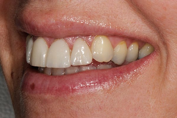 Mississauga tooth reshaping and bonding