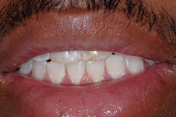 full mouth reconstruction