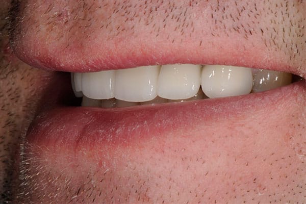 Veneers before and after