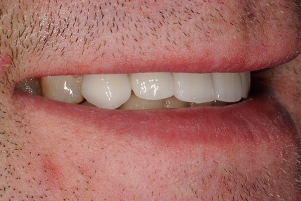 Smile enhancement transformation photo