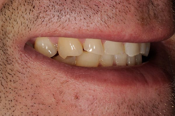 Cosmetic dental surgery results