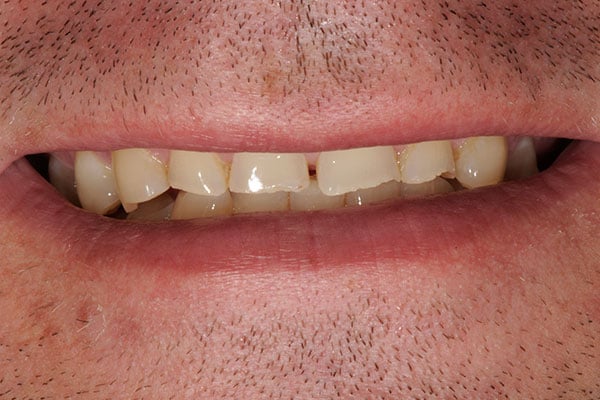 dental implants for a complete smile